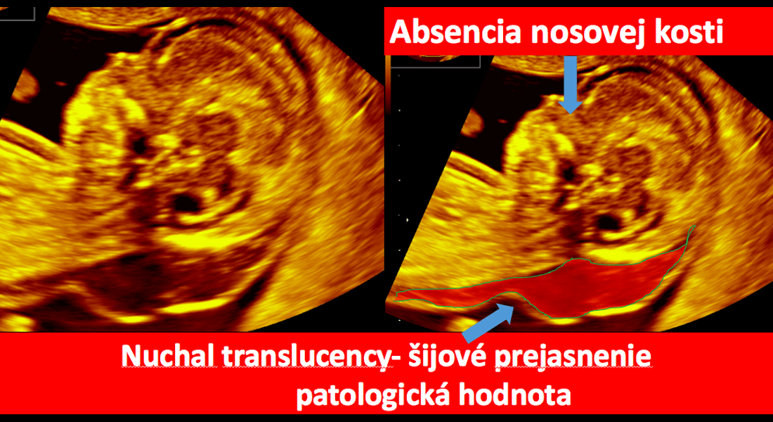 Nuchal translucency- šijové prejasnenie / patologická hodnota